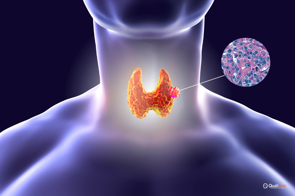 Hürthle Cell Thyroid Cancer: A Rare but Intriguing Subtype - Qualisure ...