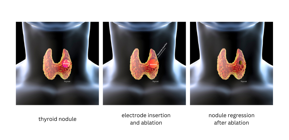 Radiofrequency Ablation: An Alternative Approach to Treating Papillary ...